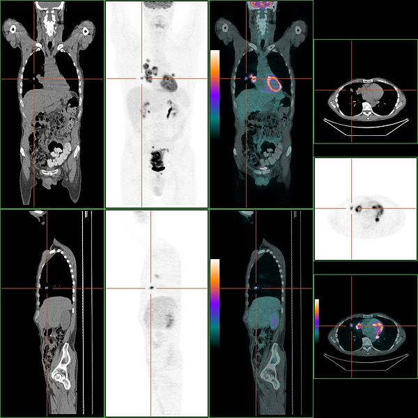 File:RectalCancerStagingInPETCT+arrow.jpg