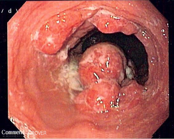 File:Esophageal adenoca.jpg