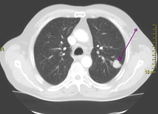 File:Thorax CT peripheres Brronchialcarcinom li OF.jpg