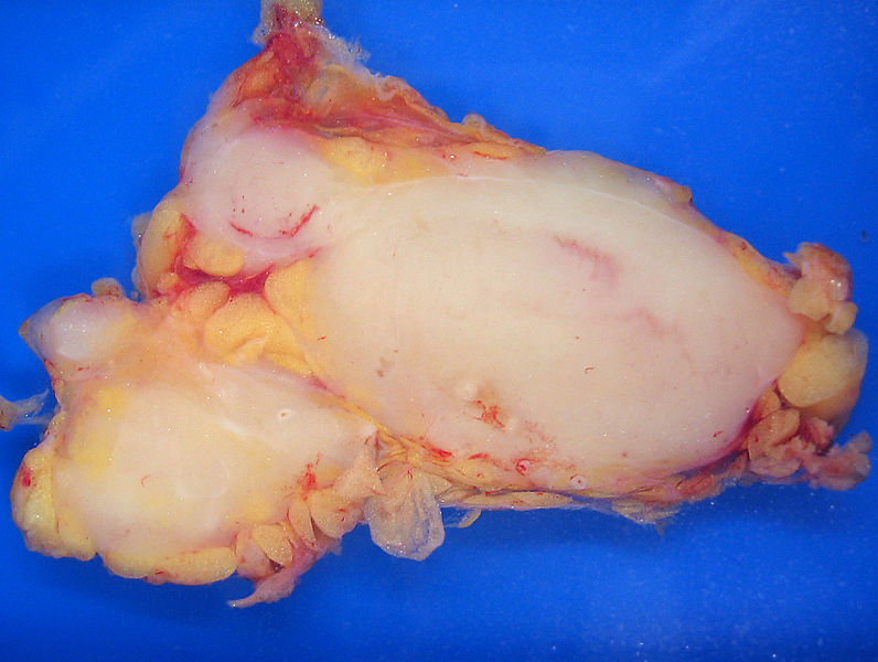 File:Lymphoma macro.jpg