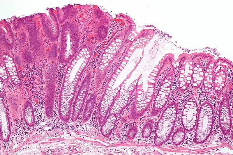 File:Tubular adenoma 2 intermed mag.jpg